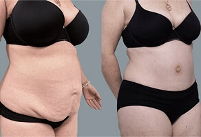 Abdominoplasty