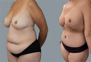 Belt Lipectomy (Body Lift)