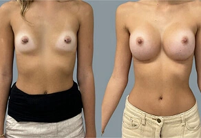 Breast Augmentation