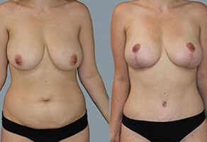 Mastopexy (Breast Lift)