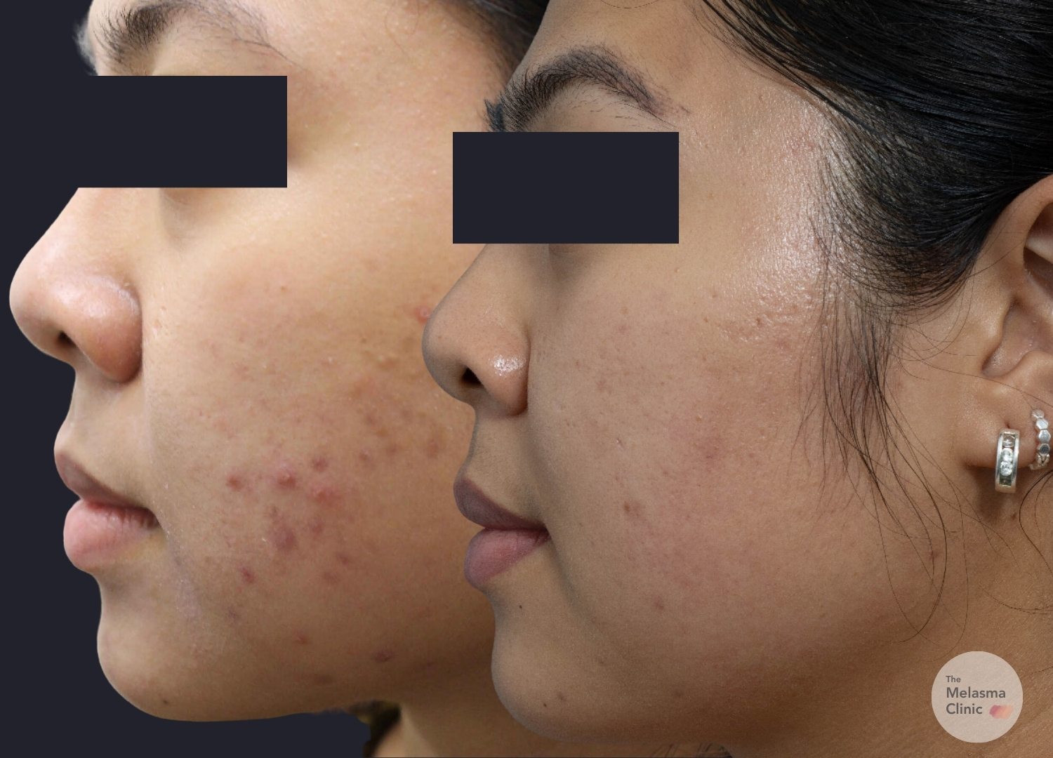 acne dark spot treatment