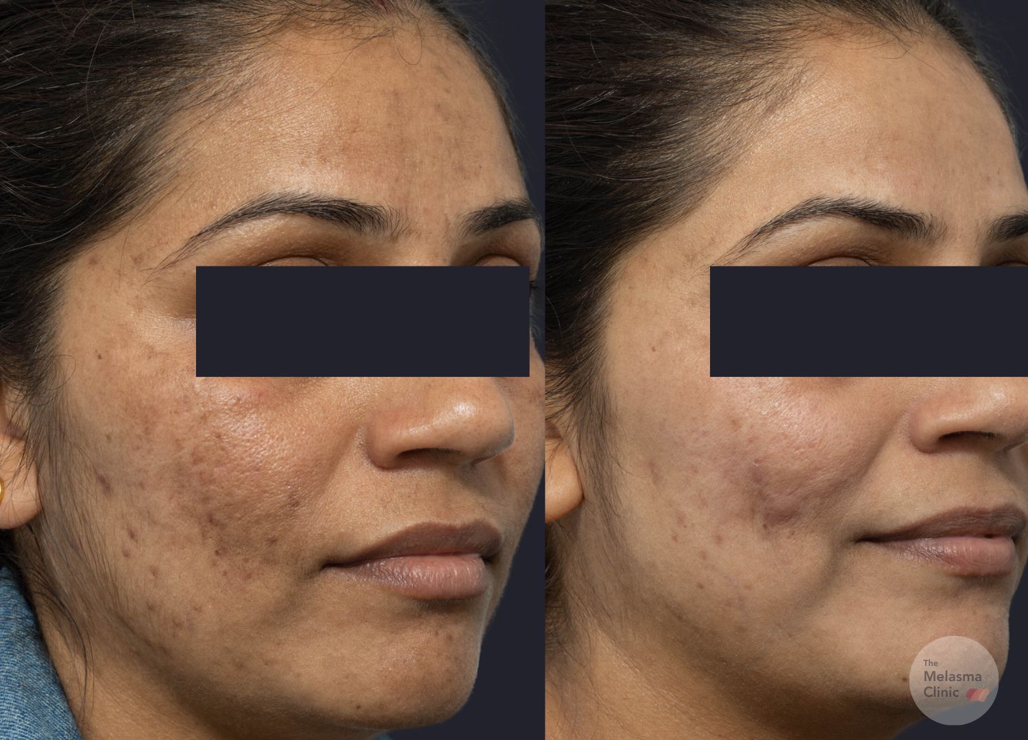 picotoning laser