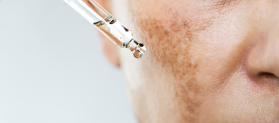 melasma during pregnancy